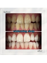 ホワイトニングショップ 岡山問屋町店/お客様のbefore&after