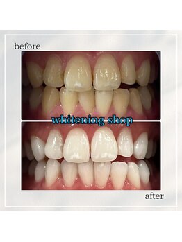 ホワイトニングショップ 岡山問屋町店/お客様のbefore&after