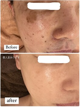 ミラ(Mila)/2年半BeforeAfter☆