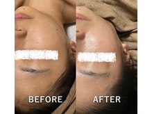 リュミエール(Lumiere)/むくみが取れて一気に小顔に！