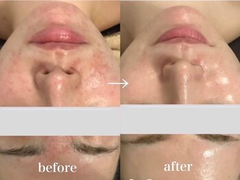 クイーンズ ピュア 新宿本店(Queen's Pure)/ヒト幹細胞順化培養液導入