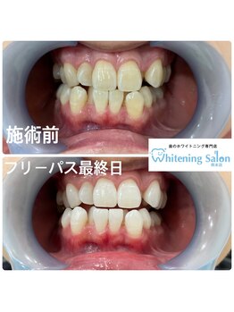 ホワイトニングサロン 熊本店/通いやすいホワイトニング