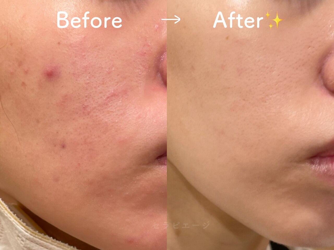 肌質改善エステサロン♡ セラピエージ｜ホットペッパービューティー
