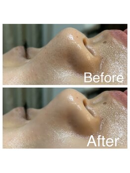 ルビー 新宿(Ruby)/いちご鼻にも◎