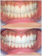 エクシアホワイトニング 札幌中島公園店/Before After［ホワイトニング］