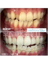 ホワイトニングサロン 福岡天神店/ホワイトニング