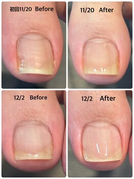 地爪ケアクリニックサロン 代々木店/巻き爪ケアジェル(2回施術後)