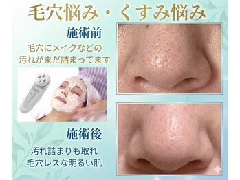 ブーケの写真/〈紫外線からの毛穴ケア対策〉毛穴つまり＆角質ケア◇開き毛穴もひきしめて陶器のようなツルスベ肌に♪