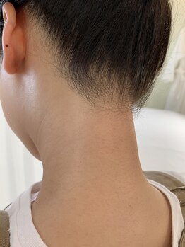 シャルマンブラン(CHARMANTBLANC)/うなじワックス脱毛