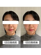 ヴィーライン 大阪梅田院(VeLine)/鍼灸／美容鍼／小顔／大阪／梅田