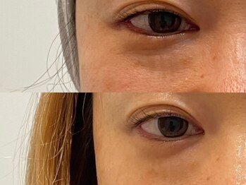 エミュ(emu)/35歳からの目元ケア