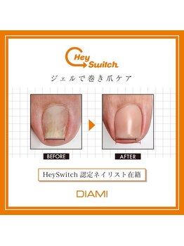 オレリ(Aureli)の写真/巻き爪ケアで痛みや違和感を軽減◎爪の状態に合わせた施術で美しい足元に♪