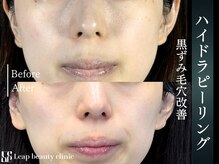 リープ(Leap)/毛穴すっきり水流洗浄