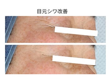 エボルブ 四条烏丸店(EVOLVE)/メイクがめり込む目元シワ改善！