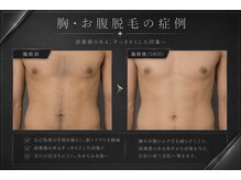 メンズラボ 京都山科店/薄着の季節に人気の胸お腹脱毛