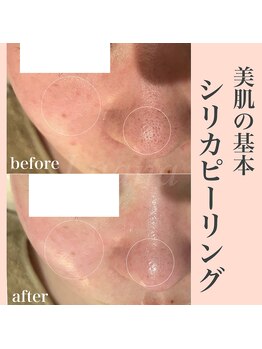 ルアナ(Luana)/【シリカピーリング】1回