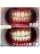 ルブラン 奈良店(Le Blanc)/笑顔に自信が持てます！