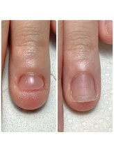 スマイルニコ(smile nico)/1ヶ月半でこの違い