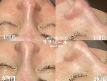 リル 和歌山市店(lilou)/ララピールで赤ら顔改善！