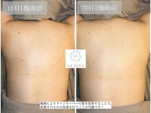 ラヴィオーラ 川西(La Viora)/ダイヤモンドハーブピーリング