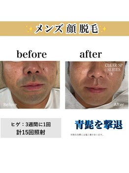 ハッピーエンジェル(Happy Angel)/メンズ顔・髭脱毛