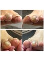 自爪ケアサロン 横浜 巻き爪、変形爪が改善!