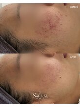 ユーエステティック(U AESTHETIC)/皮脂を除去する圧出ケア