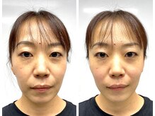 アザブハリーク(AZABU HARIEQ)/症例写真 30代女性（1回施術）