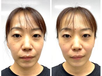 アザブハリーク(AZABU HARIEQ)/症例写真 30代女性（1回施術）