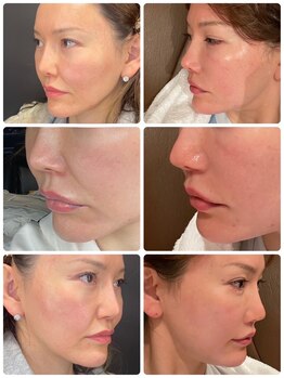 スペチアーレ 夙川/リフトアップ、法令線暖和