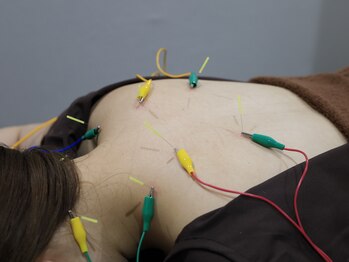 リベルタ鍼灸整骨院 新宿院(Liberta鍼灸整骨院)/深層筋にもアプローチ