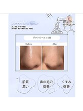 肌イズム つくば店(肌ism)/【before&after】ダクトピール