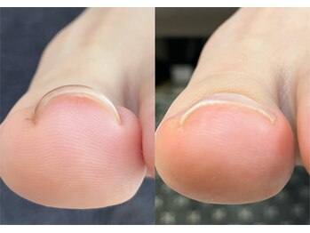 ロンディネ(Rondine)/巻き爪ケア&ネイルトリム