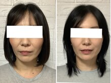 ビューティフルムーン(Beautiful Moon)/小顔矯正プログラム終了☆