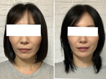 ビューティフルムーン(Beautiful Moon)/小顔矯正プログラム終了☆