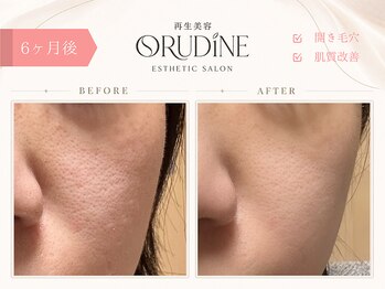 オルディーネ(ORUDiNE)/開き毛穴引き締め