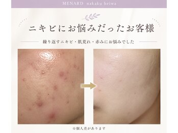 メナードフェイシャルサロン 中区平和の写真/【金山駅徒歩6分】大人女性のための本格肌質改善フェイシャル/AI肌分析付き