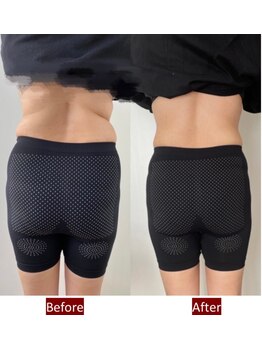 岩田整骨院神経整体院/【トランスビート】寝るだけ痩身