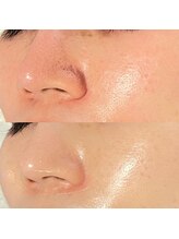 ピュアグレース 自由が丘/毛穴の黒ずみ ボコボコ毛穴に◎