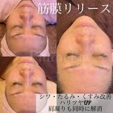 プルメリア(Plumer’a)