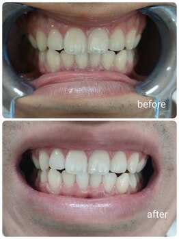 エクシアホワイトニング 秋田大町店/ビフォーアフター