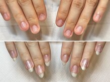 グラシュータン(gracieux temps)/深爪矯正