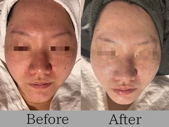 ルミライズ(lumirise)/〈3回目での効果〉