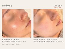 メレ(mele)/20代毛穴／ニキビケア・赤み