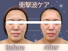 パッパ(PAPPA)の雰囲気(衝撃波小顔/深層ケアだから悩みの根本にアプローチ/18歳以上限定)
