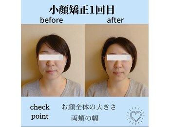 RKY/小顔矯正&頭蓋骨矯正1回(20代)
