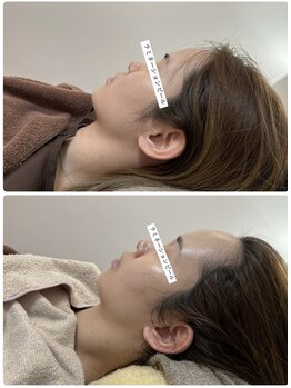 陽月 鍼灸院整骨院/ラミネーションピール