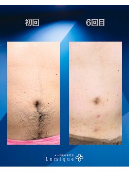 ルミーク(Lumique)/お腹 6回目 症例　O様