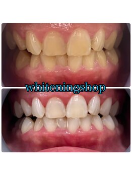 ホワイトニングショップ 武蔵小杉店/【BeforeAfter】5回 施術後比較