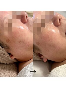 エステドブルー(Este de Bleu)/ビフォーアフター